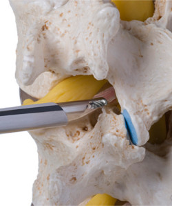 Spine Endoscopy Services at Indian Spinal Injuries Centre